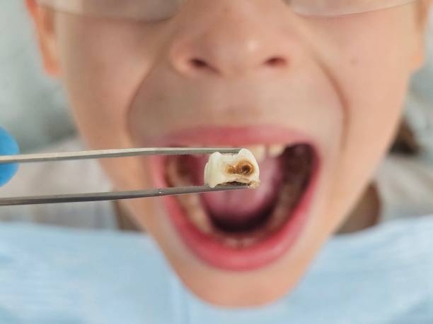 Best Emergency Dentist for Lost Fillings or Crowns in Huron, OH
